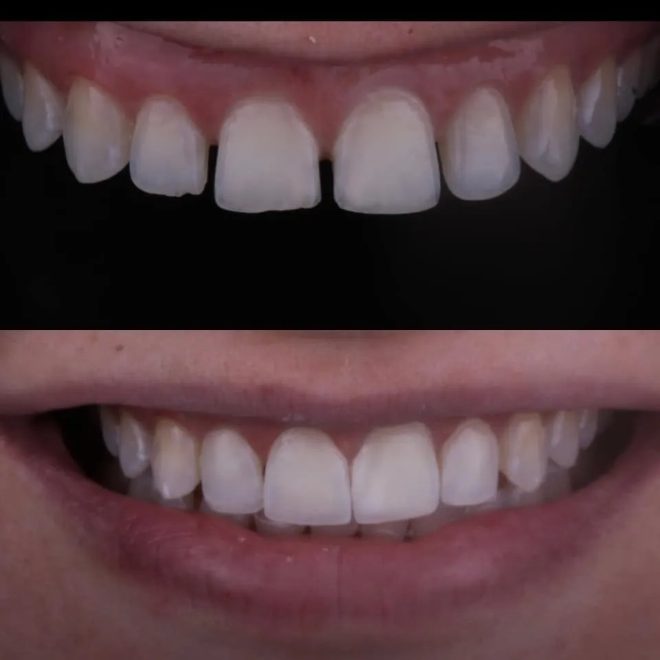 Ultradent Uveneer Template Refills